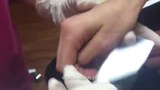 Treating nevus araneus broken capillaries with electrocautery For medical education NSFE