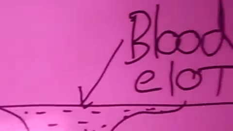 How blood clot increases blood pressure?