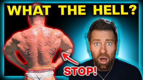 STEROID ACNE NIGHTMARE (WARNING: Graphic Photos!)