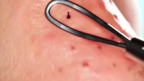 How blackhead extraction works