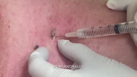 Removal of seborrheic keratoses with scissor excision For medical education NSFE
