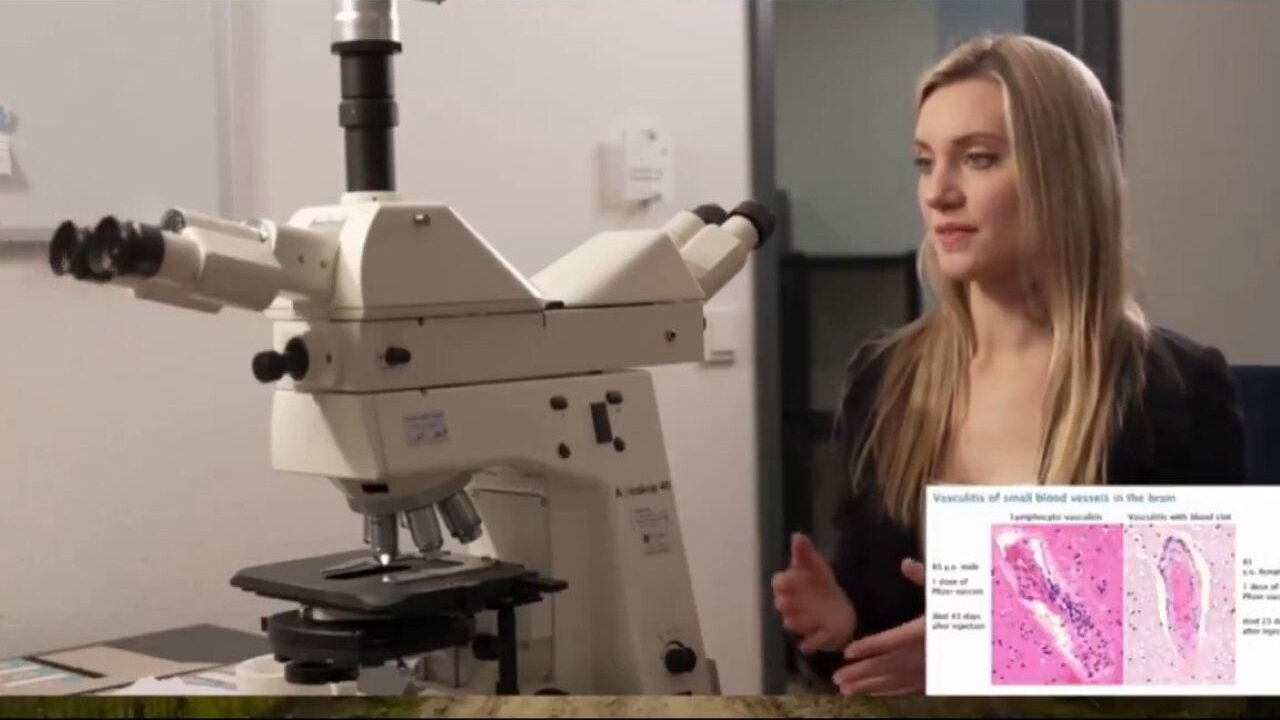 Japanese Scientists Discover mRNA Spike From Vaccine In Cerebral Arteries… Increasing Risk Of Stroke