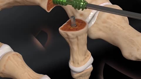 Hammer Toe Surgery 3D Animation