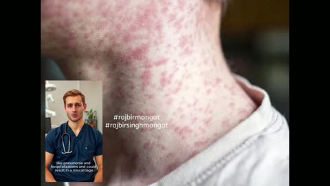 Alberta measles cases surpass 1,000