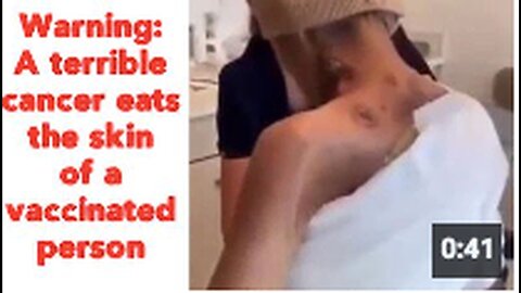 "Alert: Severe Skin Cancer Strikes Vaccinated Individual"