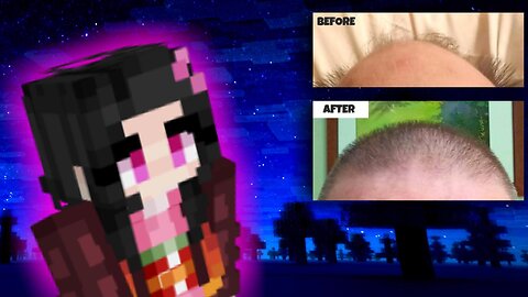 My Hair LOSS & REGROWTH Story While I Play MINECRAFT - Minoxidil (Rogaine) Finasteride & Dermaroller
