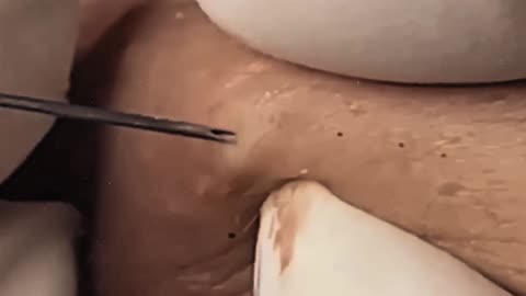 New satisfying blackhead removal (ASMR) #15