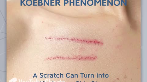 Ever wonder if your skin has a secret "copycat" mode? | #KoebnerPhenomenon #Advancells #StemCells