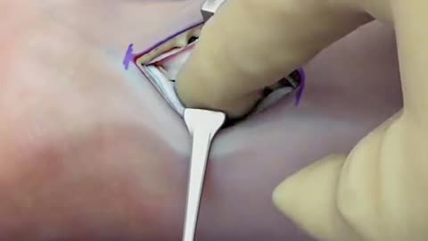 Wrist Fracture Repair Surgery - Distal Radius Fracture