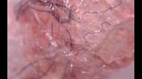 Unusual skin parasite, 2025.