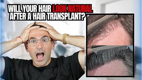 How We Create a Natural-Looking Hairline – Doctor Reveals the Technique