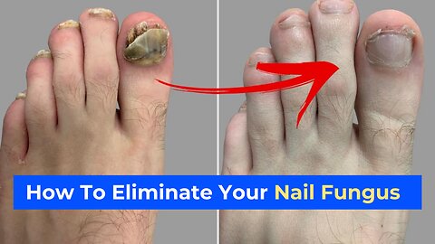 How To Get Rid of Your Nail Fungus