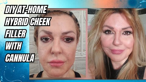 DIY AT-HOME CaHa Cheek Filler - Cannula