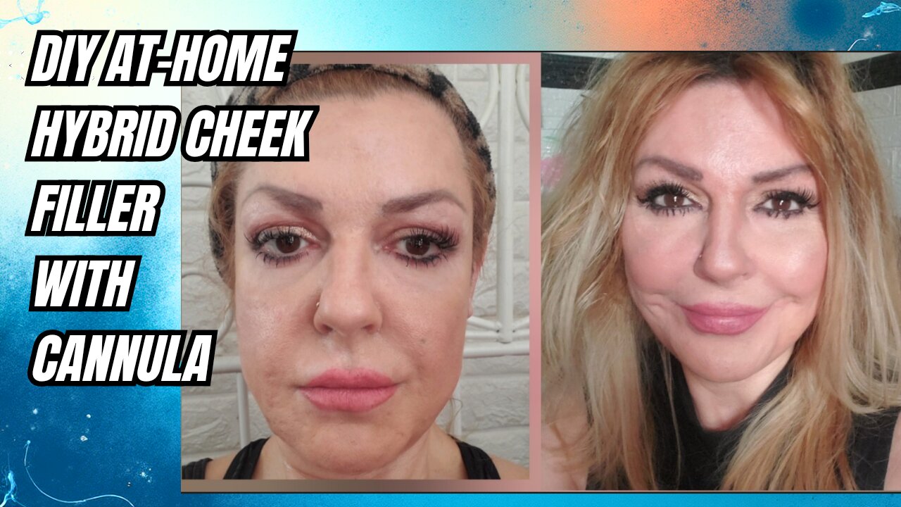 DIY AT-HOME CaHa Cheek Filler - Cannula