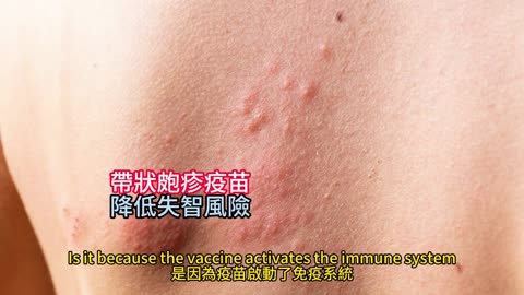 帶狀皰疹疫苗 降低失智風險