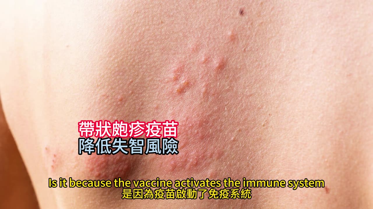 帶狀皰疹疫苗 降低失智風險