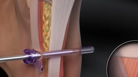 Endoscopic Plantar Fasciotomy Procedure 3D Animation