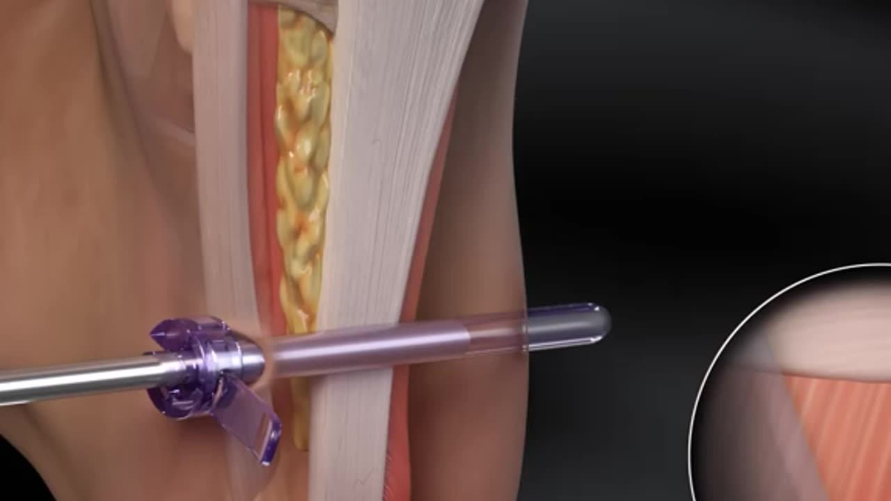 Endoscopic Plantar Fasciotomy Procedure 3D Animation