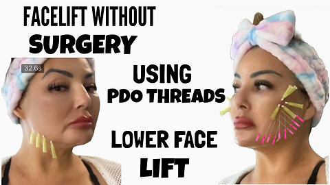 PDO Threads Tightening the Jawline And Lower Face Lift