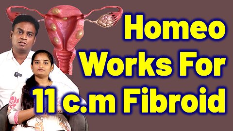 Does Homeopathy Cure 11 c.m Fibroids ? | Best Uterine Lumps Fibromyoma Treatment Medicine Surgery