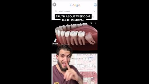 Truth About Wisdom Teeth Removal