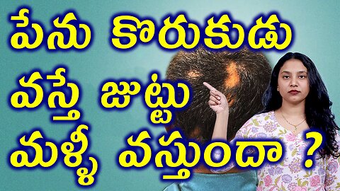 పేను కొరుకుడు వస్తే జుట్టు మళ్ళీ వస్తుందా? How to Get Rid of Alopecia Areata? Homeopathy Treatment