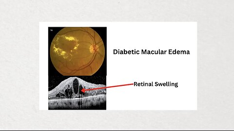 Red Light Therapy Eye Health Miracle_