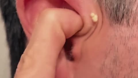 Pimple removal satisfying video (ASMR) #1 #shorts