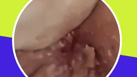 Blackhead removal new this week (ASMR) #14 #shorts