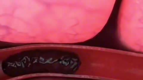 How Doctors Remove Blood Clot Near The Brain