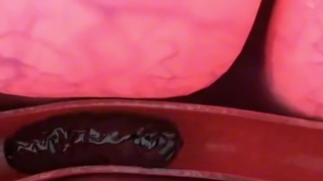 How Doctors Remove Blood Clot Near The Brain