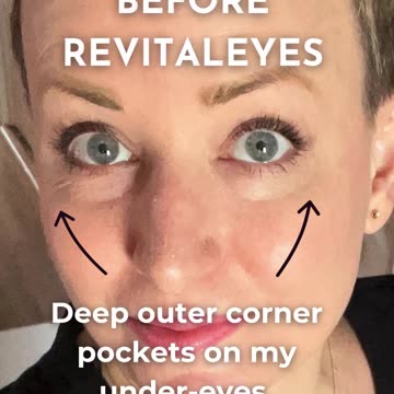 30 days of using Revitaleyes red light microcurrent instead of under eye fillers