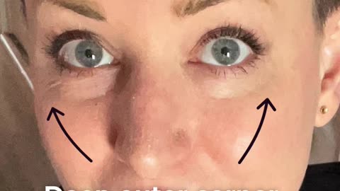 30 days of using Revitaleyes red light microcurrent instead of under eye fillers