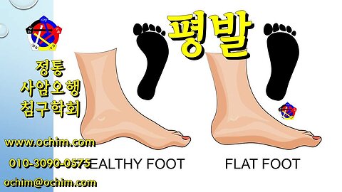 편평발(평발) 치료 방법과 후기 - 사암오행침, 사암침법, 오행침, 정통사암침