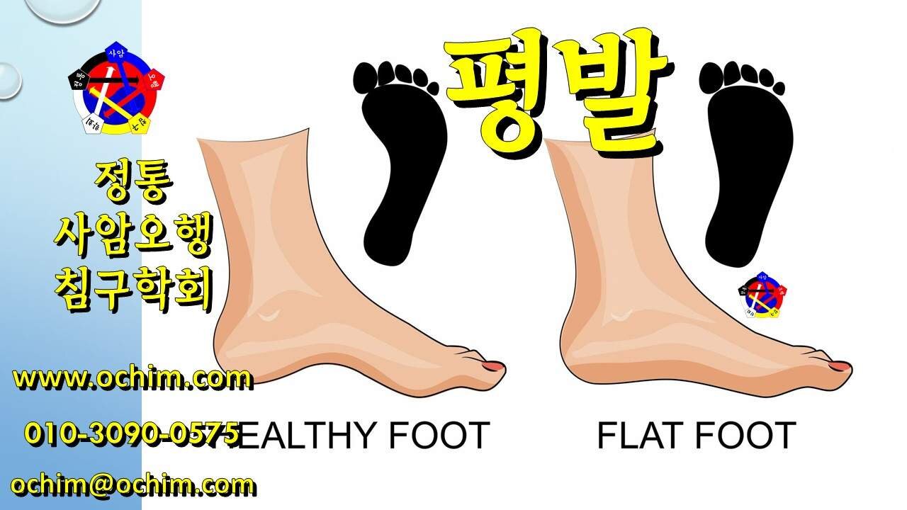편평발(평발) 치료 방법과 후기 - 사암오행침, 사암침법, 오행침, 정통사암침