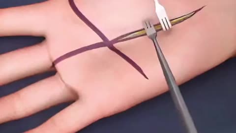 Numb Hands & Wrist Pain Here’s How CTS Surgery Fixes Carpal Tunnel Fast!