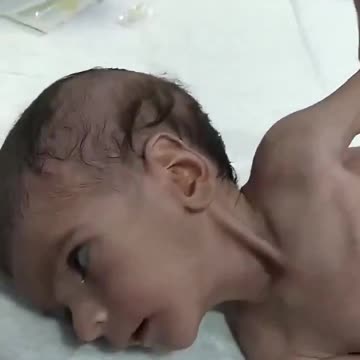 Starving Palestinian Baby