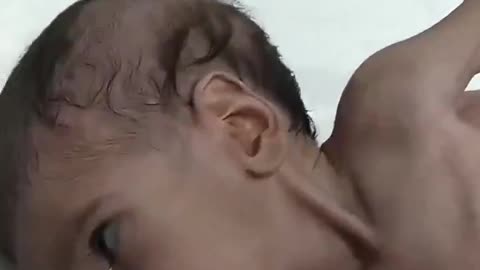 Starving Palestinian Baby