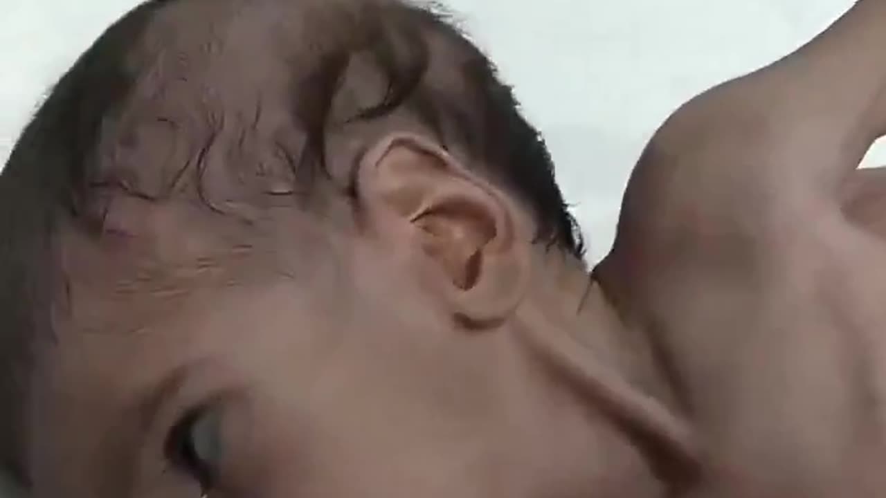 Starving Palestinian Baby