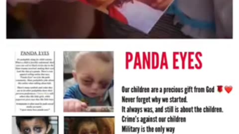 PANDA EYES HAPPEN AFTER A CHILD HAS BEEN REPEATEDLY SEXUALLY ABUSED