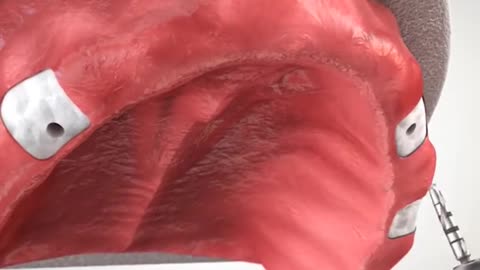 Maxillary Overddnture 3D Animation