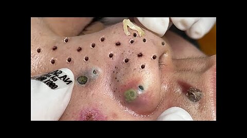 blackhead removal and Pimplepopper Spa relaxation #10114
