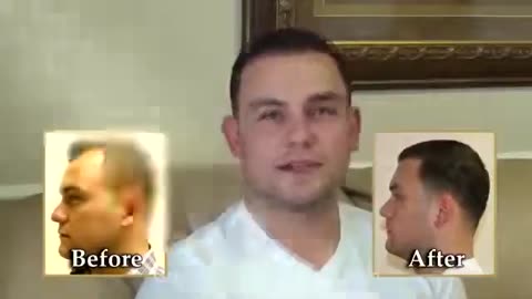 Marine Hair Restoration with Dr. Brett Bolton | MaxHarvest™ Technique