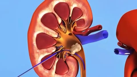 How kidney stones surgery is conducted