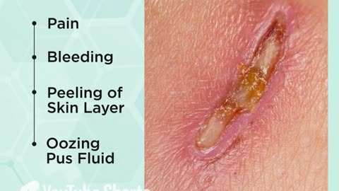 Symptoms of Skin Abrasions | #Advancells #StemCellTherapy