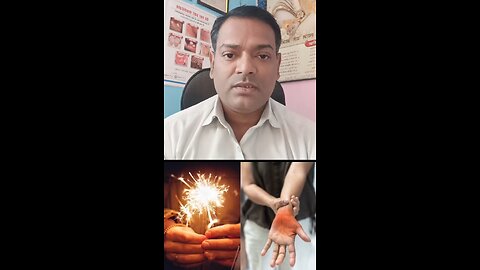पटाखे से जल जाने का इलाज ।