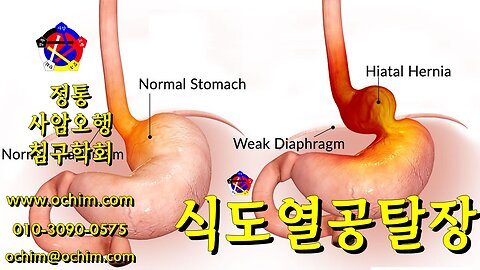 식도열공탈장 원인과 치료방법 - 사암오행침, 사암침법, 오행침, 정통사암침