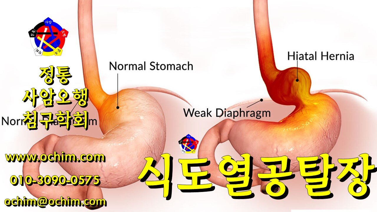 식도열공탈장 원인과 치료방법 - 사암오행침, 사암침법, 오행침, 정통사암침