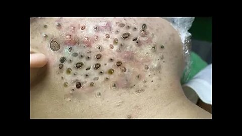 Blackheads Removal & Pimple Popper Cystic Acne Extraction #224