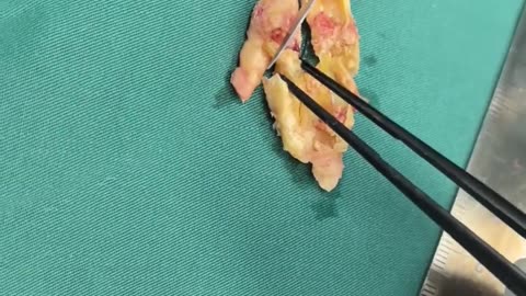 🤯✨ This Carotid Plaque Is Insanely Hard! | FeedMyCuriosity